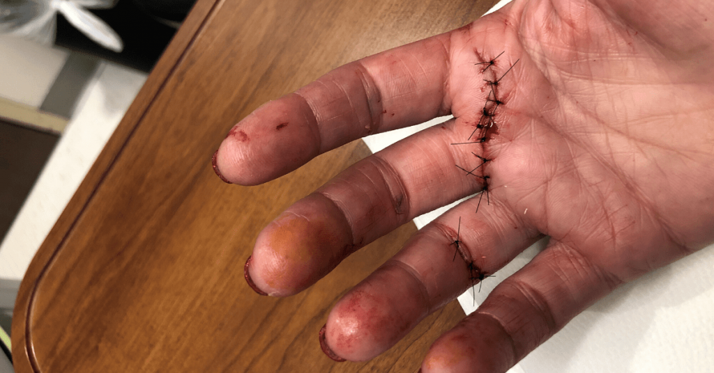 Dr. Taylor's hand injury.