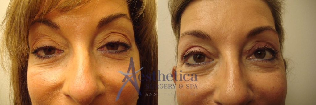 Close-up of a patient's eyes before and after upper eyelid surgery.