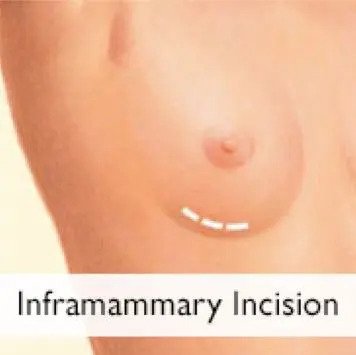 Inframammary Incision