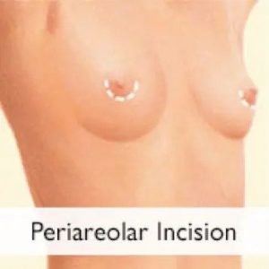 Periareolar Incision