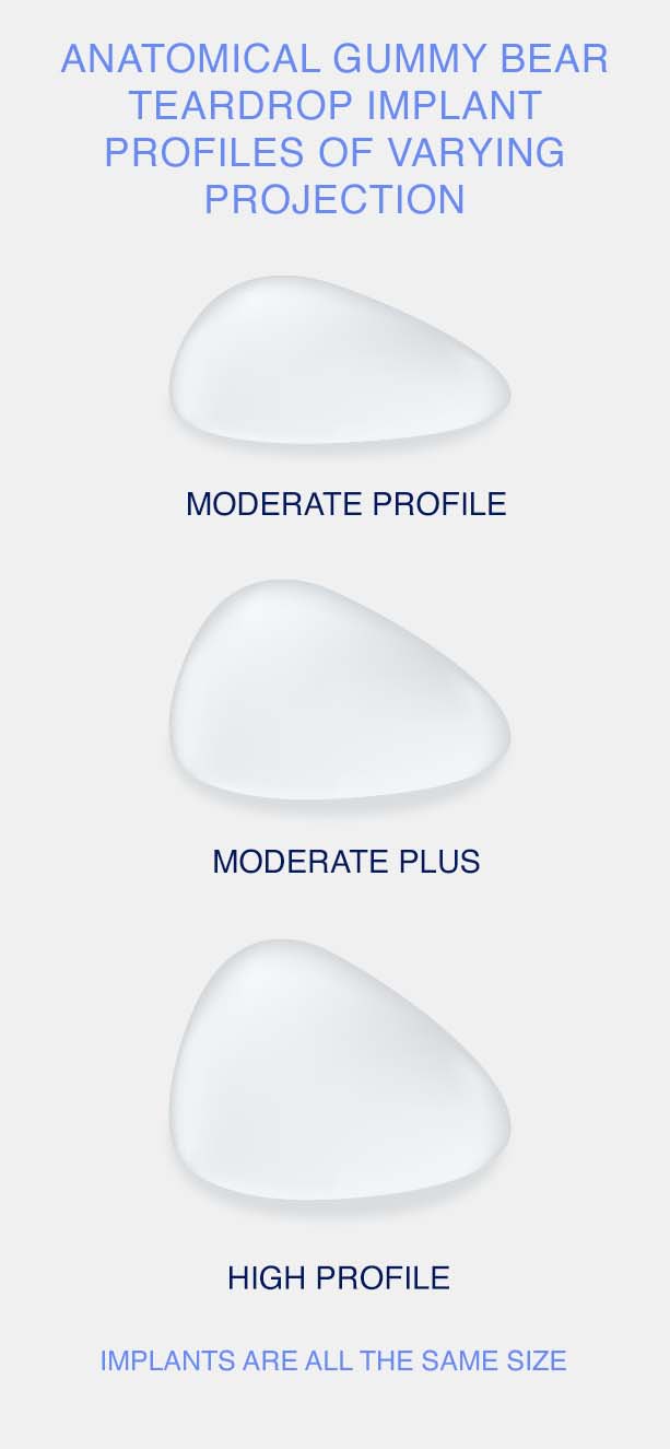 Anatomical gummy bear teardrop implant profiles of varying projection.