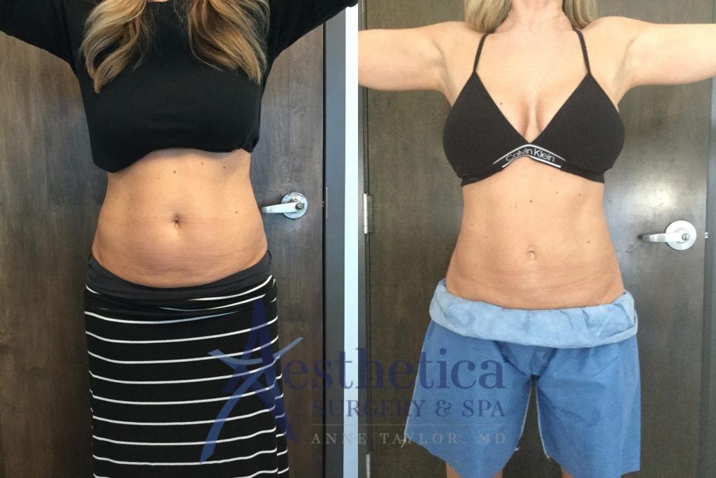 A 51-year-old female's bare midsection before and after CoolSculpting treatment.