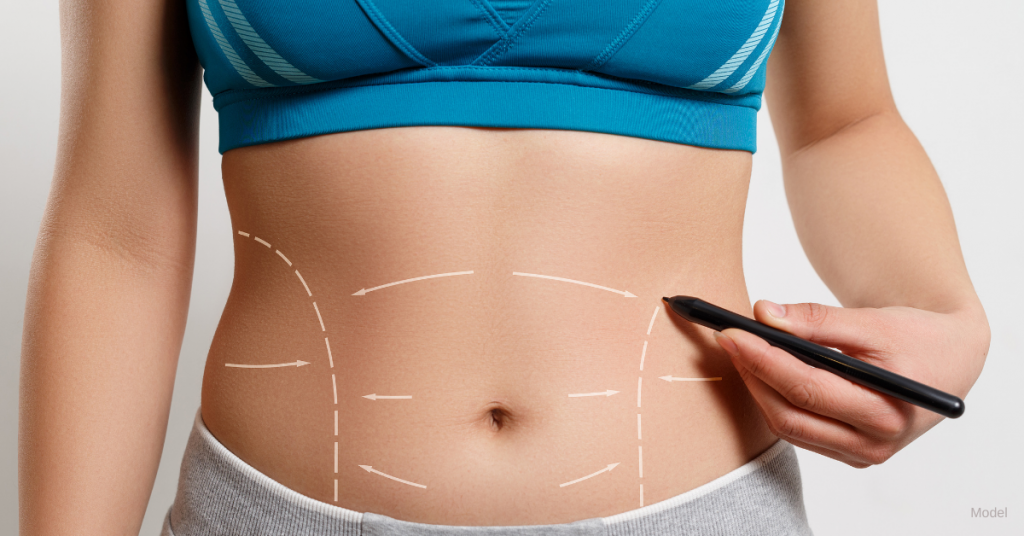 Woman considering Coolsculpting in Worthington, OH.