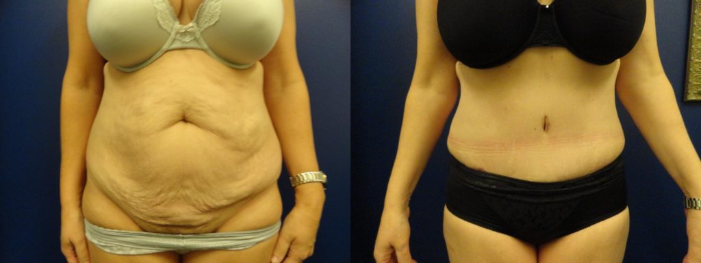 View of woman's midsection before and after a tummy tuck.