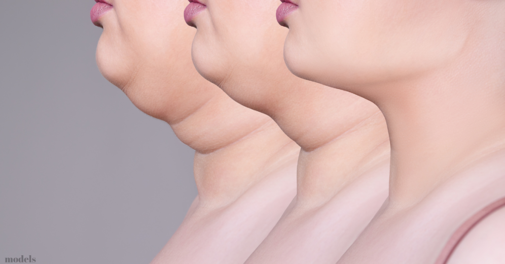 3 model progression of woman losing her double chin (models)