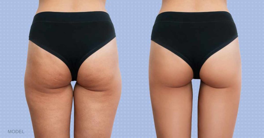 Woman legs on the left with cellulite and woman legs on the right without cellulite. (MODEL)